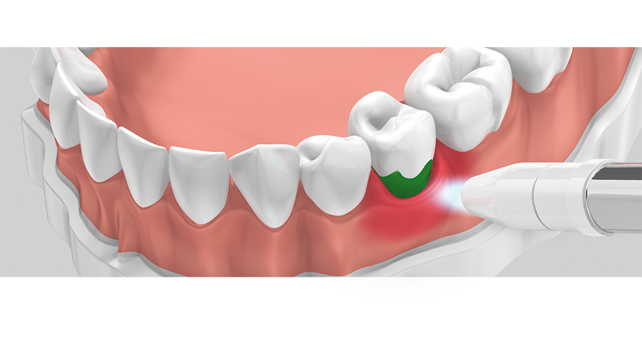 3. Laserenergie aktiviert den Farbstoff durch das Zahnfleisch – Bakterien sterben ab