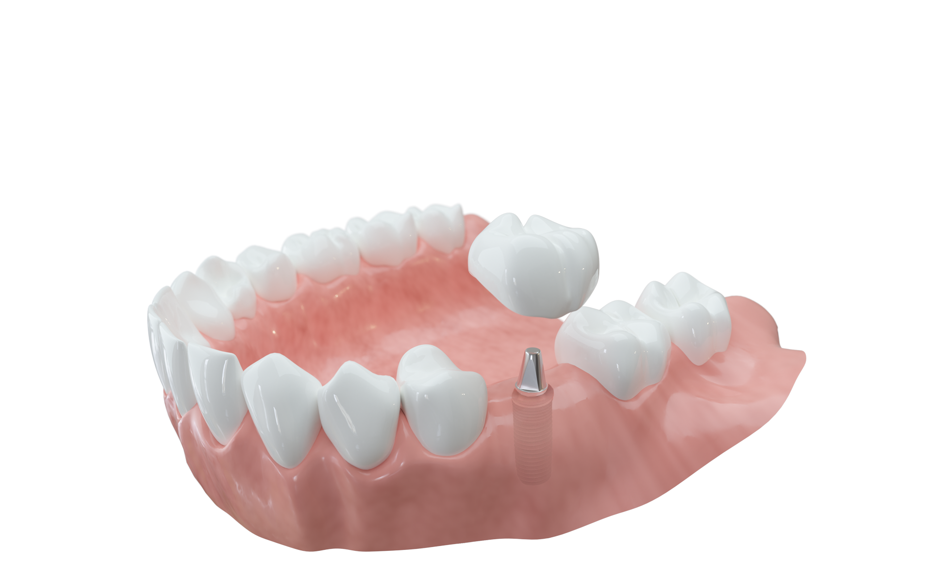 Ein Zahn fehlt Ein Implantat hat gegenüber einer Brücke den Vorteil, dass Nachbarzähne nicht beschliffen werden müssen.