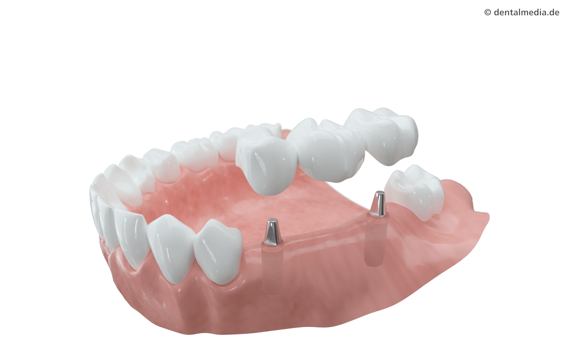 Mehrere Zähne fehlen. Die fehlenden Zähne werden durch Implantate ersetzt, auf die eine Brücke aufgesetzt wird. Nachbarzähne bleiben voll erhalten.