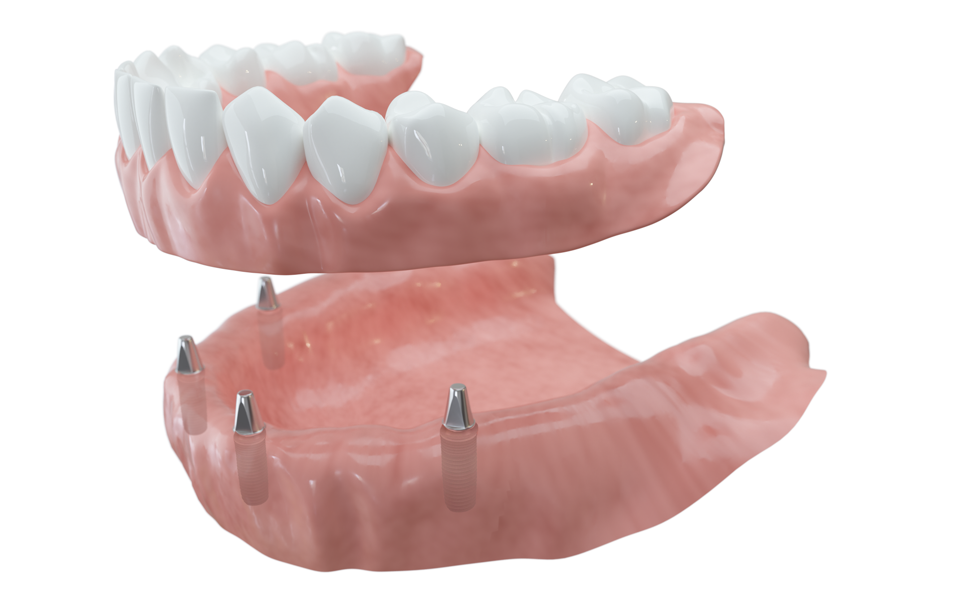 Sehr viele oder alle Zähne fehlen Mit mehreren Implantaten haben Teil- oder Vollprothesen, herausnehmbar oder festsitzend, einen festen Halt.